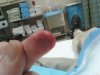 bite at hospital.jpg bite at hospital.jpg