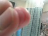 p bite at hospital aftr cleaning.jpg