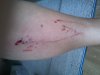 burm bite 004.jpg