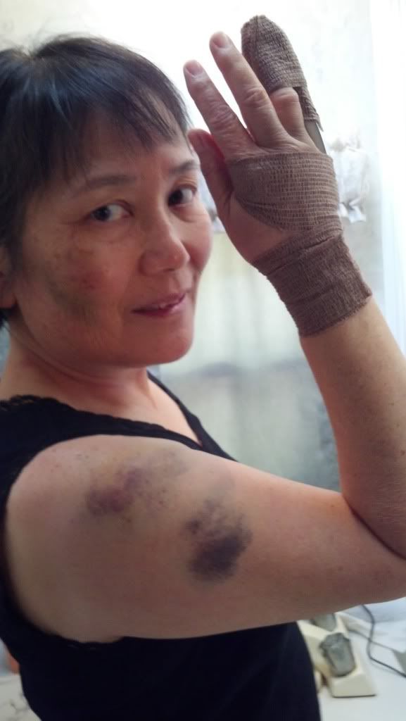 bruise-1.jpg