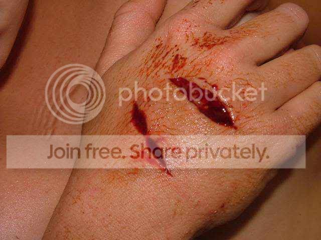 vikki_big_bite_wound.jpg